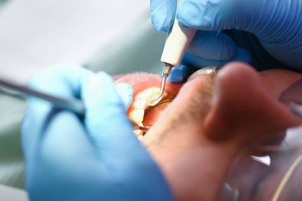 Best Emergency Tooth Extraction in Bromley, KY